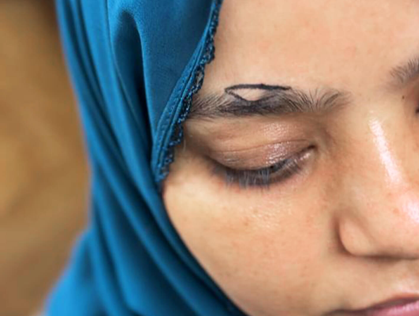 Eyebrow transplant before after